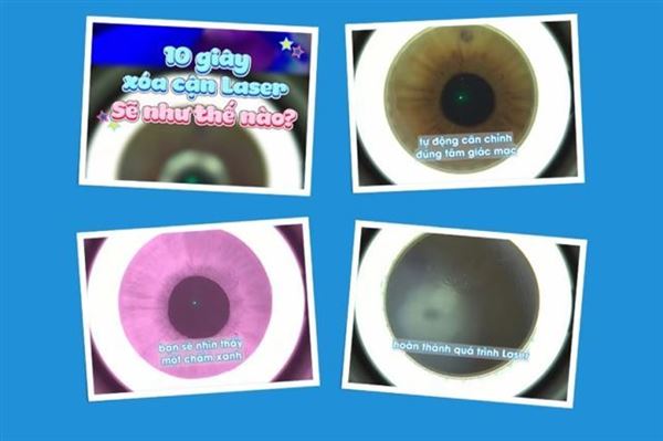 Video: 10s laser trong xóa cận Smile Pro sẽ như thế nào?