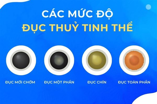 Xác định giai đoạn phẫu thuật phù hợp theo mức độ đục thủy tinh thể