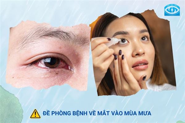 Cảnh báo: 4 bệnh về mắt thường gặp vào mùa mưa 