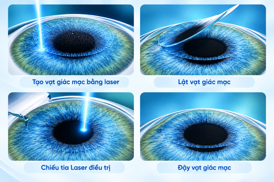 Lão thị: 3 lầm tưởng phổ biến và giải pháp điều trị bằng Presbyond