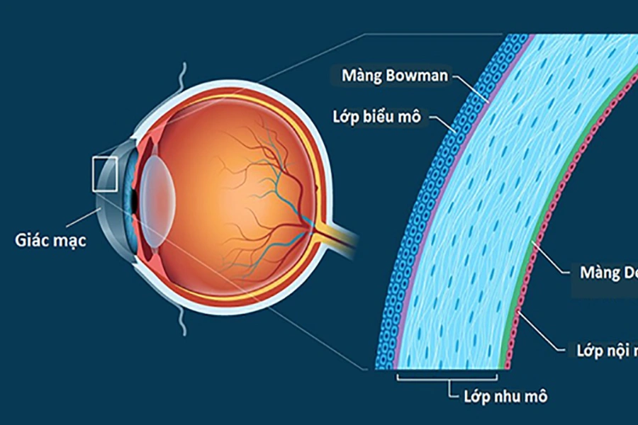 Các thuật ngữ quan trọng cần biết trước khi phẫu thuật xóa cận