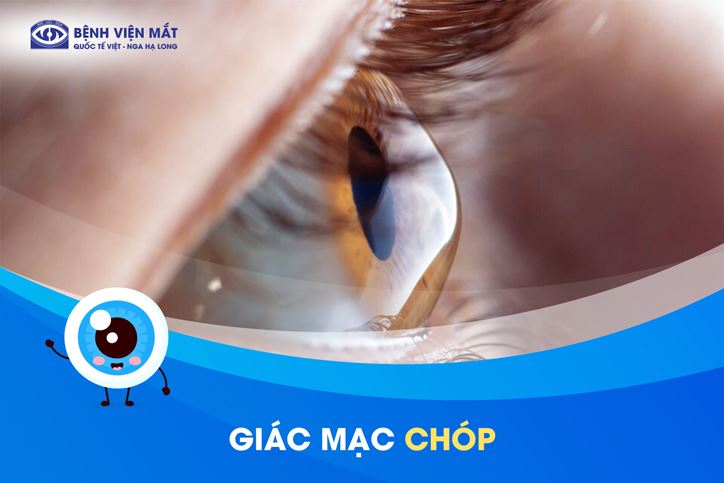 Giác mạc hình chóp là gì? Có nguy hiểm không?