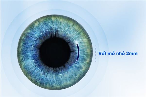 Video: Cận cảnh quy trình laser trong xóa cận Smile Pro