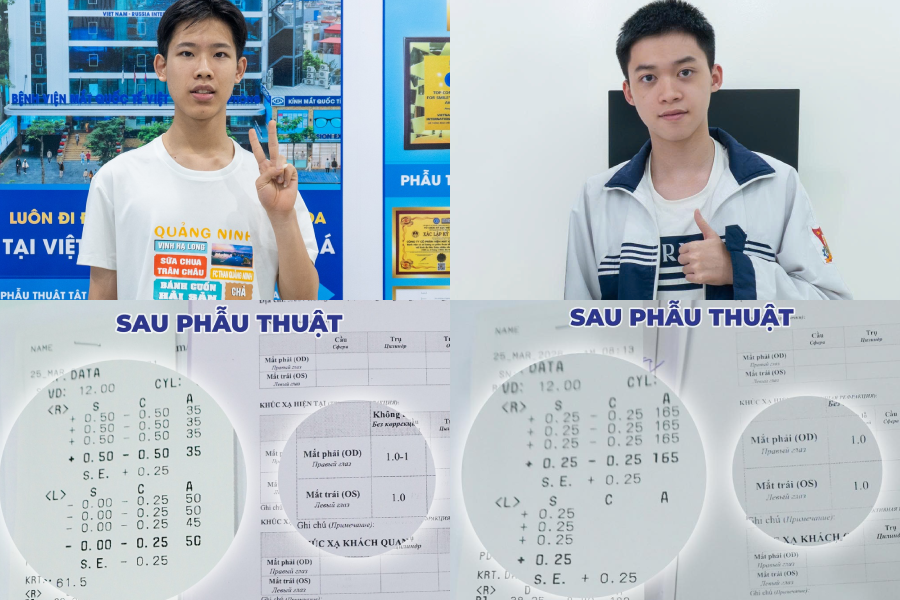 Phẫu thuật Super Smile Pro, hai nam sinh cận hơn 5 độ đạt thị lực 10/10 thi quân đội
