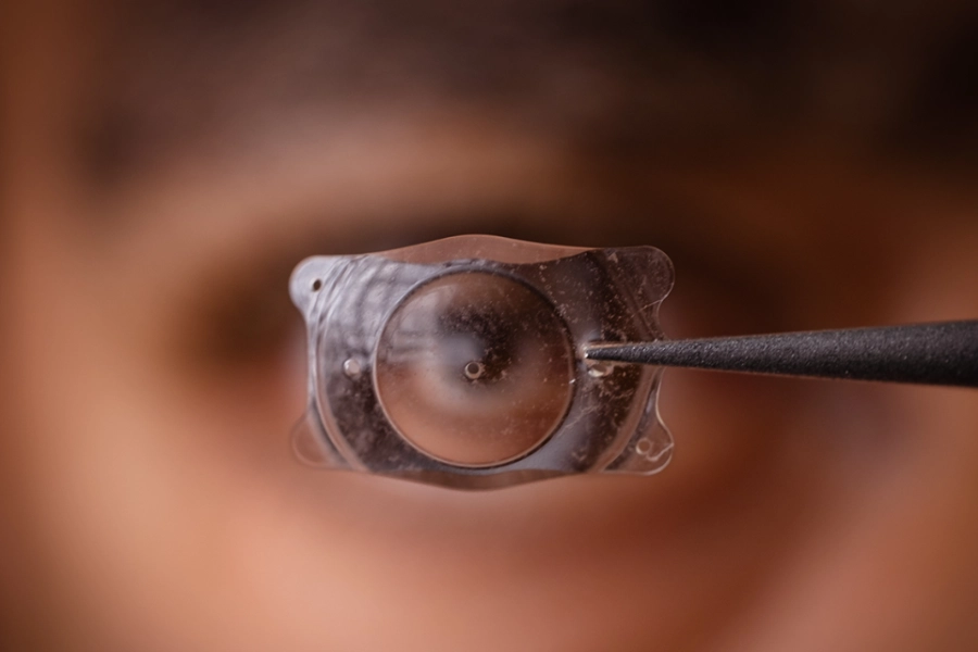 Xóa cận Phakic: Thấu kính tí hon loại bỏ cặp kính dày cộp