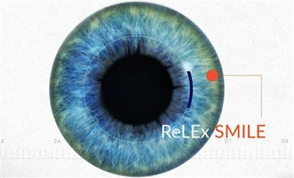 Relex Smile手术是什么？ Relex Smile手术程序