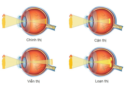 Tổng quan về Tật khúc xạ