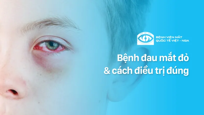 Đau mắt đỏ do virus, điều trị thế nào mới đúng?